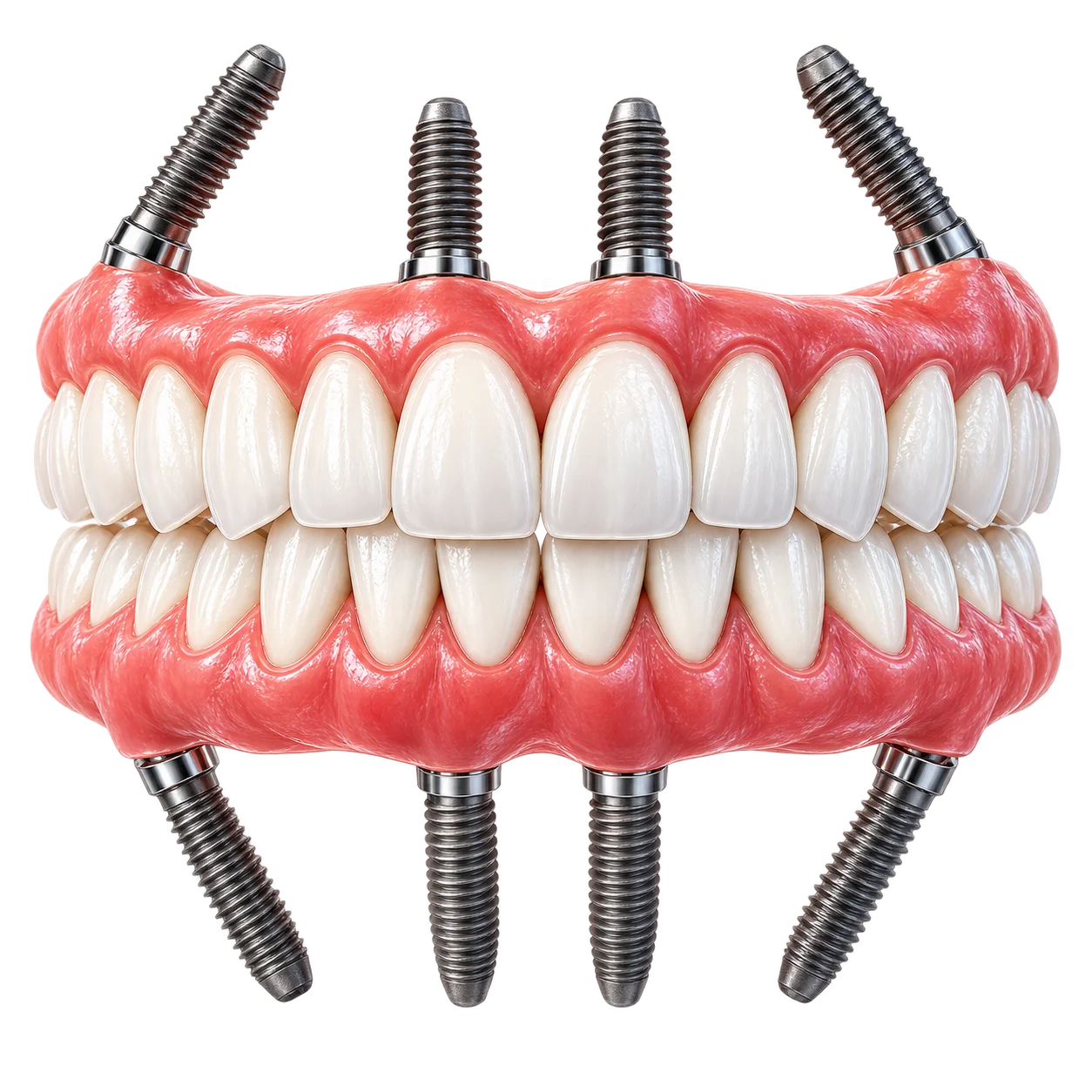 All-on-four Odbudowa zębów na 4 implantach all-on-x.png