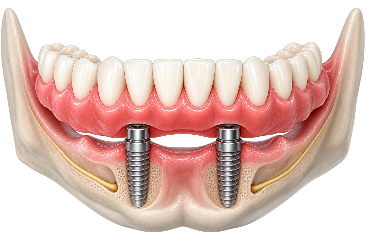 Proteza zębowa mocowana na dwóch implantach proteza-mocowana-na-2-implantach.png